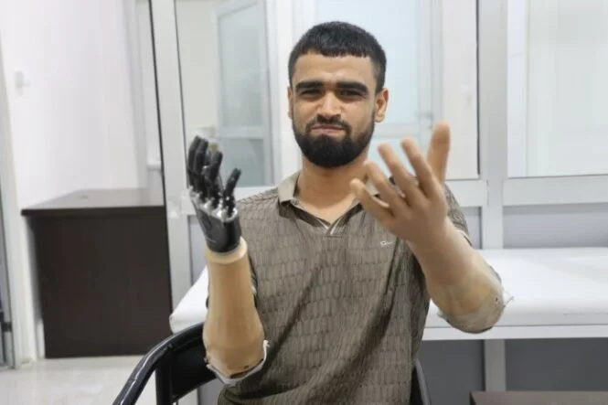 DEMİRİN ELEKTRİK TELLERİNE DEĞMESİYLE HAYATI KARARAN MUHAMMED, 3 MİLYON TL DEĞERİNDEKİ PROTEZ BACAĞINA VE 2 BİYONİK KOLUNA KAVUŞTU